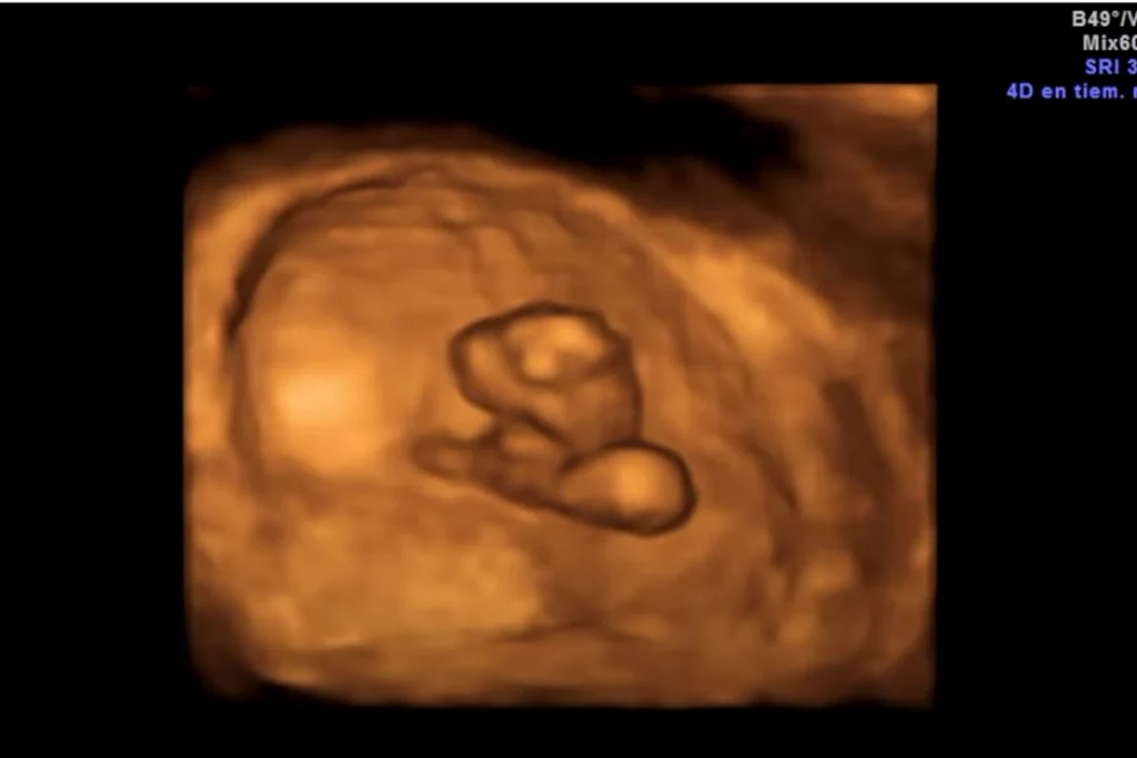 What to Expect at 7 Week Ultrasound