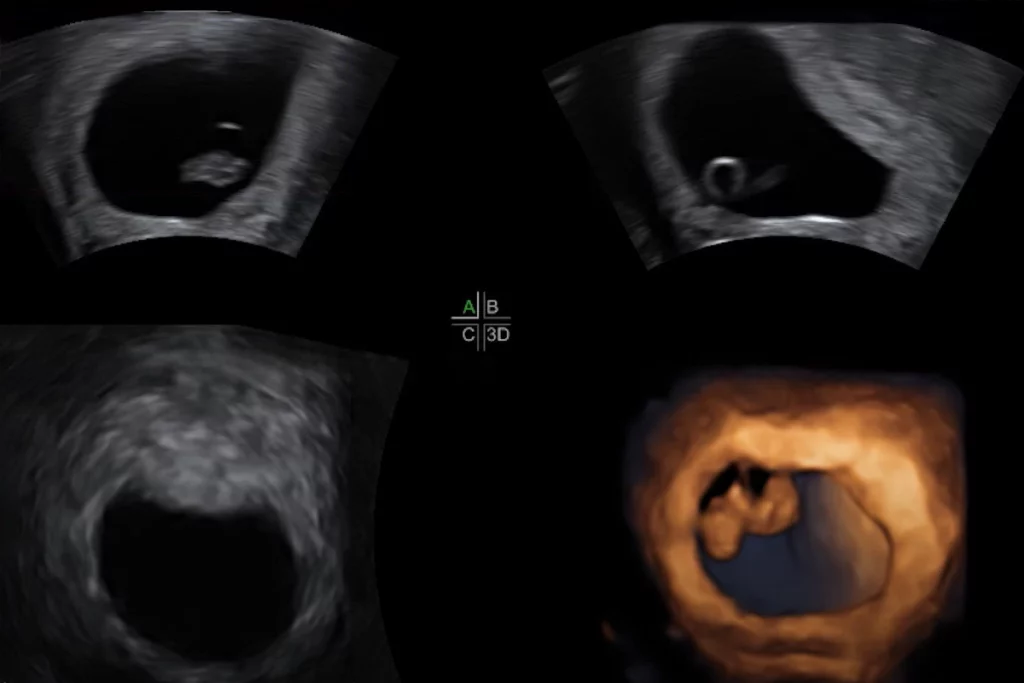 What Can You Learn from the 6 Week 3D Ultrasound