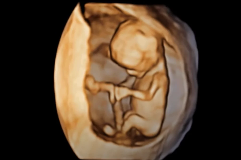 Why is the 12 Week 3D Ultrasound Important