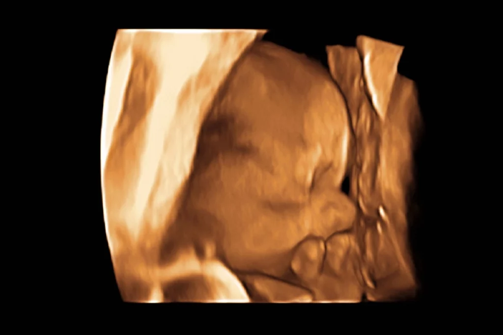 3D Ultrasound at 16 Weeks