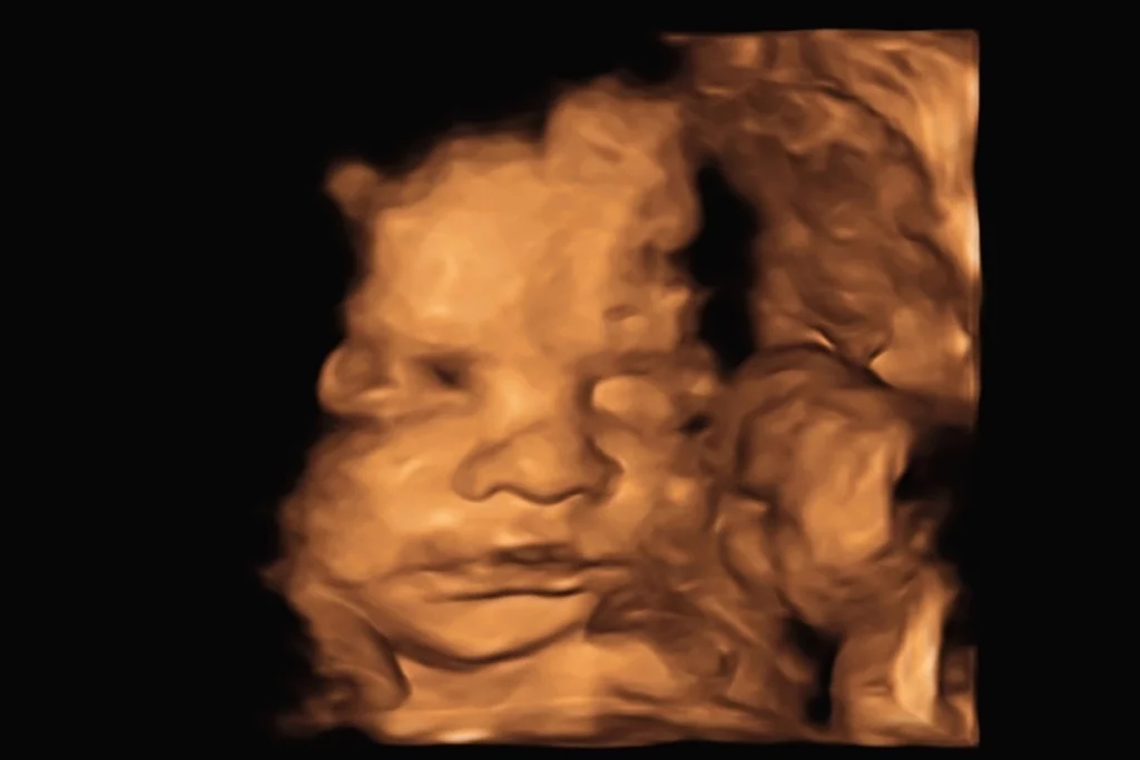 What Can You See in A 15 Week 3D Ultrasound?